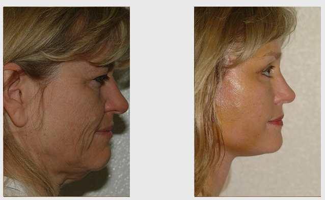 Stem Cell Facelifts Discerning The Facts From The Myths Beverly Hills Ca Stem Cell Plastic